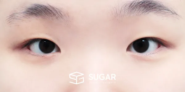 슈가성형외과 첫) 자연유착 + 눈매교정 + 앞트임 전후사진 - 수술 전