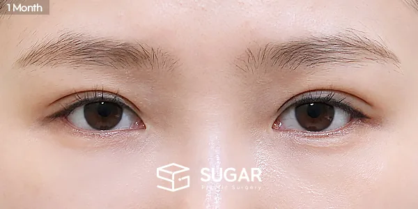 슈가성형외과 재) 재수술 + 자연유착 + 눈매교정 + 뒤밑트임 전후사진 - 수술 후