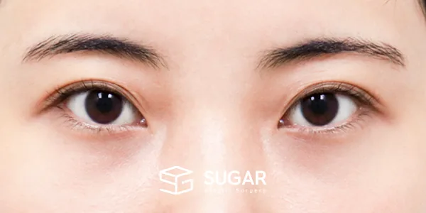 슈가성형외과 첫) 뒤밑트임 전후사진 - 수술 전