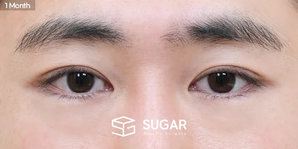 슈가성형외과 재) 재수술 + 자연유착 + 눈매교정 전후사진 - 수술 후