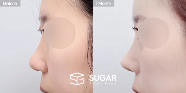 슈가성형외과 첫) 무보형물+절골+복코+귀연골 전후사진 - 측면 수술 전후 비교