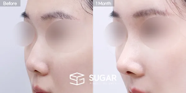 슈가성형외과 첫) 콧대+코끝+매부리코+짧은코+비중격연장+비주연장+자가늑 전후사진 - 45도 수술 전후 비교