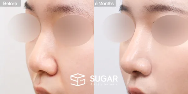 슈가성형외과 첫) 콧대 + 코끝 + 복코 + 비중격 + 귀연골 전후사진 - 45도 수술 전후 비교