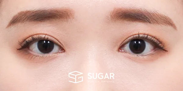 슈가성형외과 첫) 자연유착 + 눈매교정 전후사진 - 수술 후