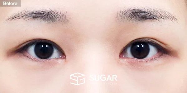 슈가성형외과 재) 재수술 + 절개 + 뒤밑트임 전후사진 - 수술 전