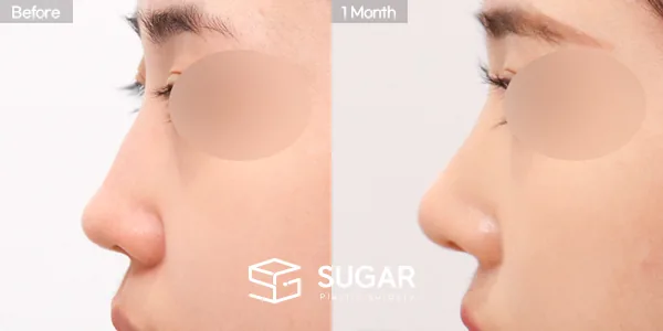슈가성형외과 첫) 콧대 + 코끝 + 매부리코 + 절골 + 비주 내리기 + 귀연골 전후사진 - 측면 수술 전후 비교