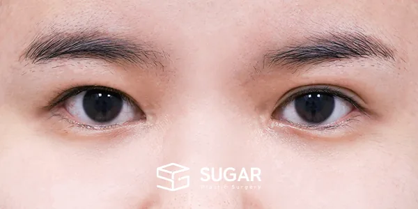 슈가성형외과 첫) 절개[R] + 뒤밑트임 전후사진 - 수술 전