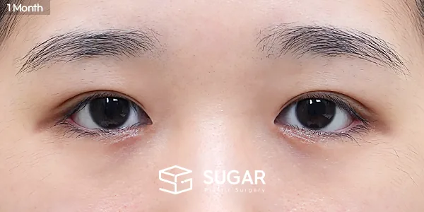 슈가성형외과 첫) 자연유착 + 눈매교정 + 앞트임 + 뒤밑트임 전후사진 - 수술 후