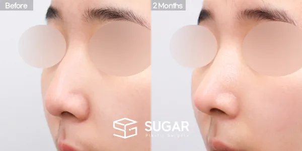슈가성형외과 첫) 코끝 + 매부리코 + 무보형물 코성형 + 절골 + 귀연골 전후사진 - 45도 수술 전후 비교