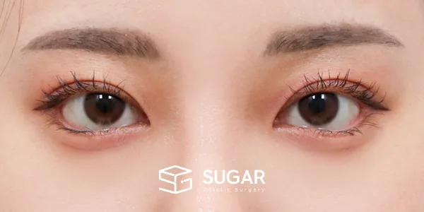 슈가성형외과 첫) 자연유착 + 눈매교정 + 뒤밑트임 전후사진 - 수술 후