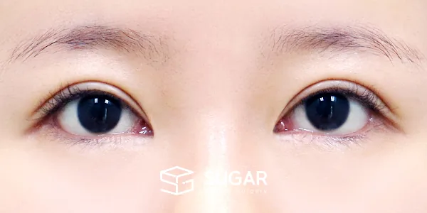슈가성형외과 재) 밑트임 재수술 전후사진 - 수술 후