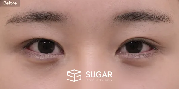 슈가성형외과 첫) 비절개눈매교정 + 윗트임 + 웨이브뒤밑트임 전후사진 - 수술 전