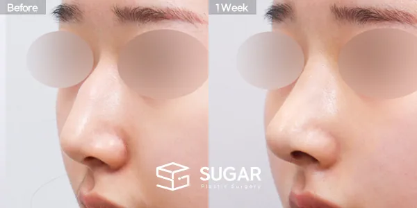 슈가성형외과 첫) 코끝 + 매부리코 + 무보형물 코성형 + 절골 + 귀 뒤 근막 전후사진 - 45도 수술 전후 비교