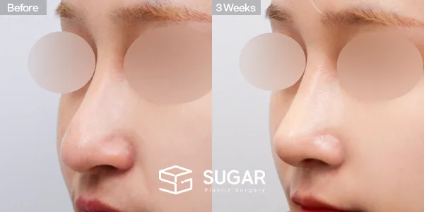 슈가성형외과 재) 재수술 + 복코 + 비중격 + 귀연골 전후사진 - 45도 수술 전후 비교