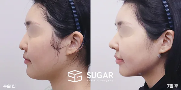 슈가성형외과 첫) 콧대+코끝+복코+비주지지+귀연골+얼굴지방흡입+민트실리프팅+입술필러+입꼬리보톡스+턱보톡스 전후사진 - 측면 수술 전후 비교