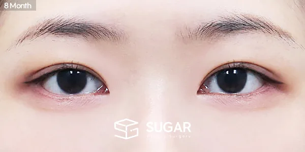 슈가성형외과 첫) 자연유착 + 눈매교정 + 윗트임 + 앞트임 + 뒤밑트임 전후사진 - 수술 후