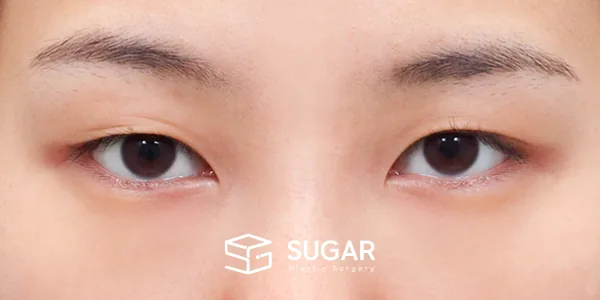 슈가성형외과 첫) 자연유착 + 눈매교정 + 윗트임 전후사진 - 수술 전