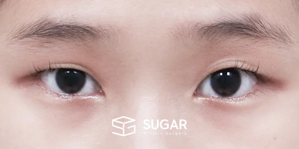 슈가성형외과 첫) 자연유착 + 눈매교정 전후사진 - 수술 전