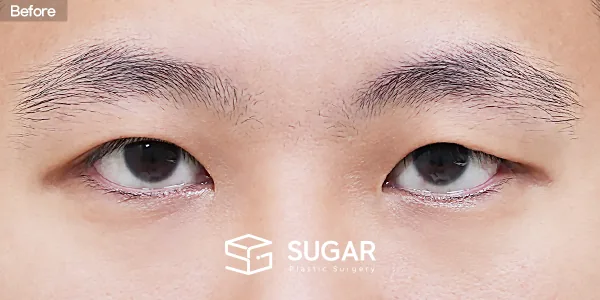 슈가성형외과 재) 재수술 + 절개 + 눈매교정 + 뒤트임 전후사진 - 수술 전
