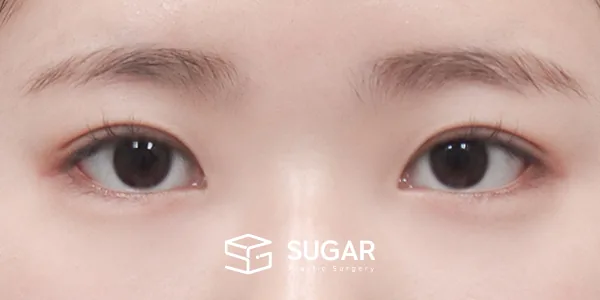슈가성형외과 첫) 자연유착 + 눈매교정 전후사진 - 수술 후