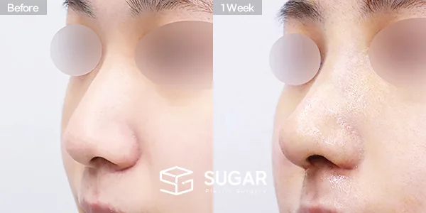 슈가성형외과 첫) 무보형물 + 비중격연골 + 귀연골 + 귀 뒤 근막 + 복코 + 매부리 + 절골 + 비주연장 전후사진 - 45도 수술 전후 비교