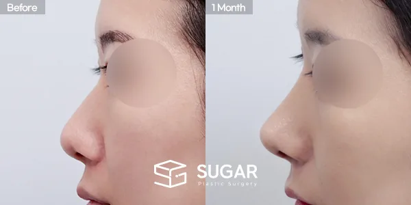 슈가성형외과 첫) 무보형물+복코+비중격연장+만곡증교정+귀연골+비중격+귀근막 전후사진 - 측면 수술 전후 비교
