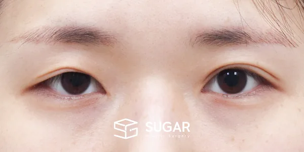 슈가성형외과 재) 재수술 + 절개 + 눈매교정 + 윗트임[R] 전후사진 - 수술 전