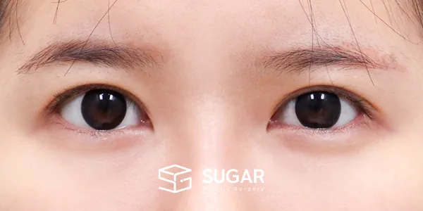 슈가성형외과 재) 재수술 + 절개(두 줄 따기) + 눈매교정 + 뒤밑트임 전후사진 - 수술 후