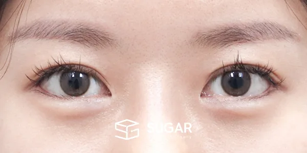 슈가성형외과 재) 재수술 + 뒤밑트임 전후사진 - 수술 후