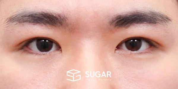 슈가성형외과 첫) 자연유착 + 눈매교정 전후사진 - 수술 후