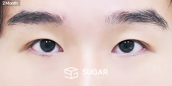 슈가성형외과 첫) 자연유착 + 눈매교정 + 윗트임 + 앞트임 + 뒤밑트임 전후사진 - 수술 후