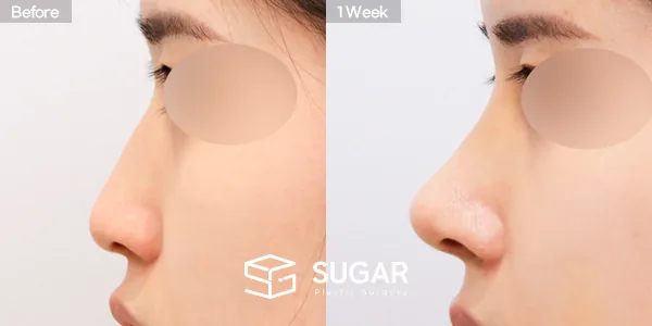 슈가성형외과 첫) 콧대 + 코끝 + 매부리코 + 복코 + 절골 + 비중격 + 귀연골 전후사진 - 측면 수술 전후 비교
