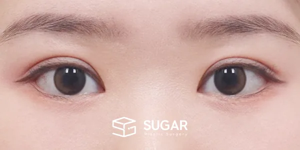 슈가성형외과 첫) 자연유착 + 앞트임 + 윗트임 + 뒤밑트임 전후사진 - 수술 후