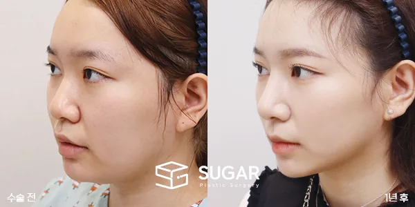 슈가성형외과 첫) 콧대+코끝+비중격+귀연골+복코교정+이중턱지방흡입 전후사진 - 측면 수술 전후 비교