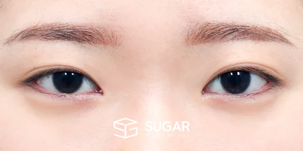 슈가성형외과 재) 절개 재수술 + 눈매교정 + 윗트임 + 뒤밑트임 + 안검내반 전후사진 - 수술 전