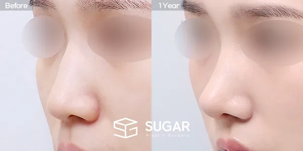 슈가성형외과 첫) 무보형물 + 절골 + 매부리 + 복코 + 귀 뒤 근막 + 귀연골 + 비중격연장 전후사진 - 45도 수술 전후 비교