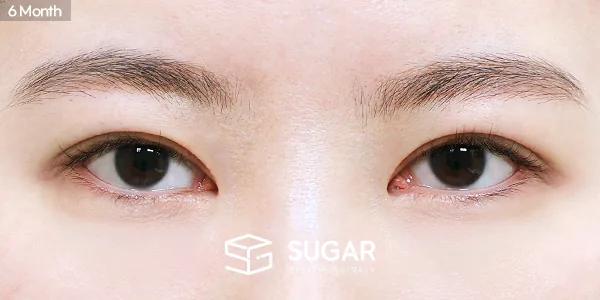 슈가성형외과 재) 재수술 + 절개 전후사진 - 수술 후