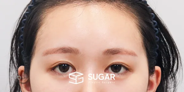 슈가성형외과 재) 이마거상 + 뒷트임 재수술 + 밑트임 + 애교필러 전후사진 - 수술 후