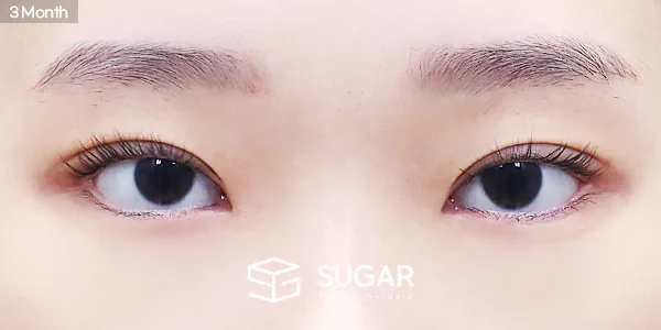 슈가성형외과 첫) 자연유착 + 눈매교정 + 윗트임 + 앞트임 + 뒤밑트임 + 눈밑지방재배치 전후사진 - 수술 후