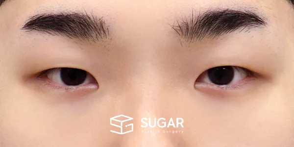 슈가성형외과 첫) 자연유착 + 눈매교정 + 앞트임 + 뒤밑트임 전후사진 - 수술 전