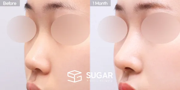슈가성형외과 첫) 콧대 + 코끝 + 매부리코 + 복코 + 절골 + 비중격 + 귀연골 전후사진 - 45도 수술 전후 비교