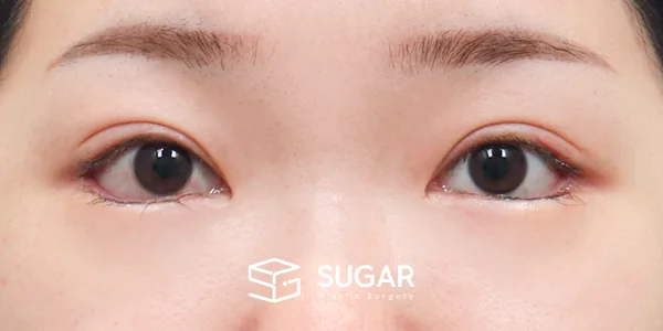 슈가성형외과 첫) 뒤밑트임 전후사진 - 수술 후