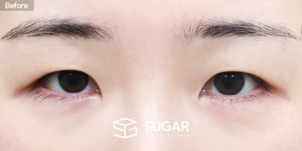 슈가성형외과 첫) 자연유착 + 눈매교정 + 앞트임 전후사진 - 수술 전