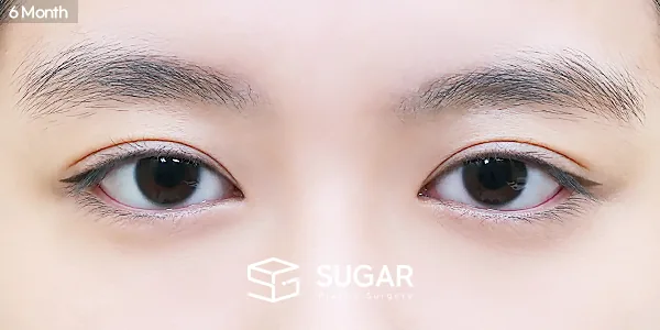 슈가성형외과 첫) 자연유착 + 눈매교정 전후사진 - 수술 후