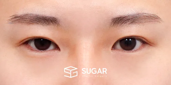 슈가성형외과 첫) 절개 + 앞트임 + 뒤밑트임 전후사진 - 수술 전