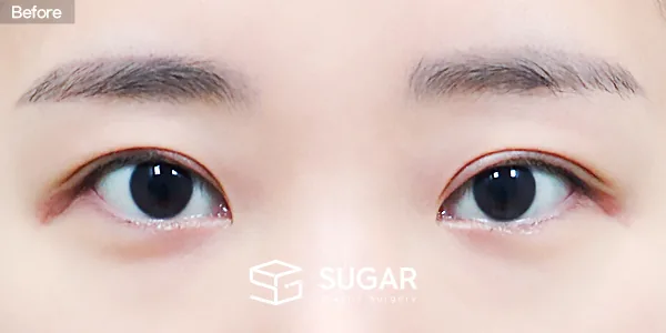 슈가성형외과 재) 재수술 + 절개 + 눈매교정 + 뒤밑트임 전후사진 - 수술 전