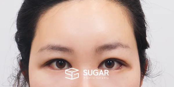 슈가성형외과 첫) 이마거상 + 자연유착 + 뒷밑트임 전후사진 - 수술 후