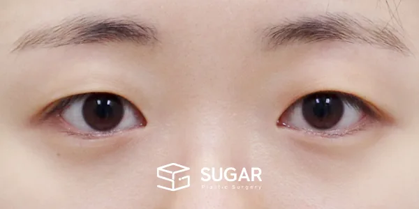 슈가성형외과 첫) 절개 + 윗트임 전후사진 - 수술 전