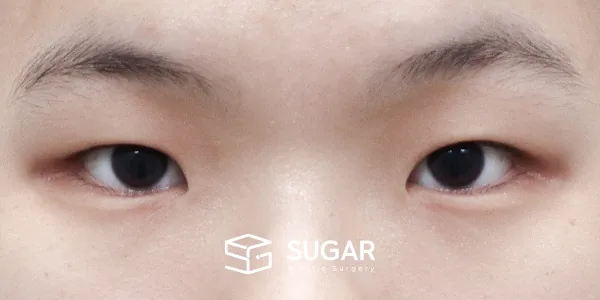 슈가성형외과 첫) 절개 + 앞트임 + 뒤밑트임 전후사진 - 수술 전