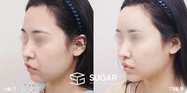 슈가성형외과 첫) 얼굴지방이식+이중턱지방흡입+심부볼제거+턱보톡스 전후사진 - 전후 비교 사진